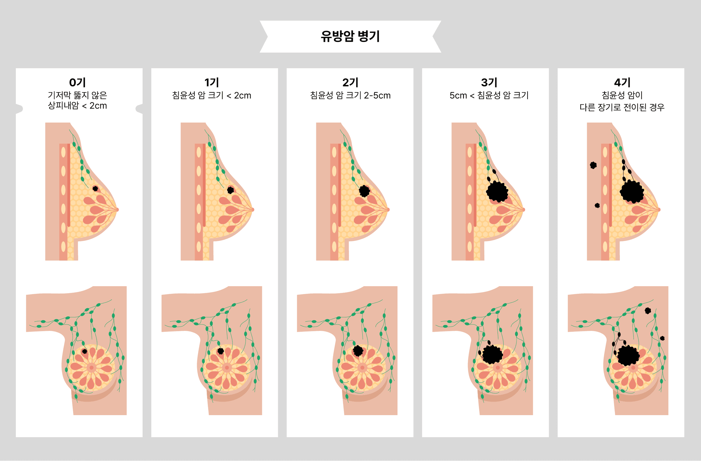 유방암 4기부터 유방암 상피내암까지 맞춤형으로
